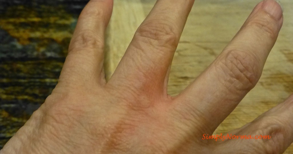 Allergic Hand